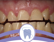 استشاري: 4 أعراض لمشكلة «طحن الأسنان»