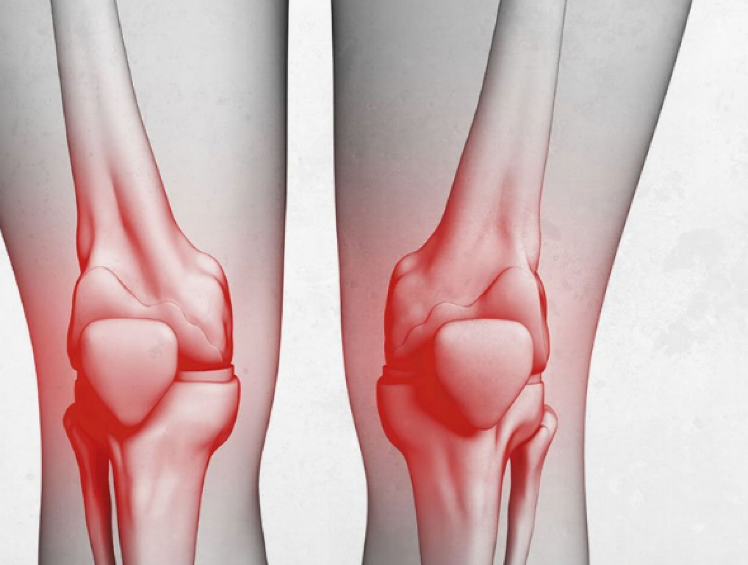 مشكلة شائعة في «الركبة».. السبب والأعراض وطريقة العلاج